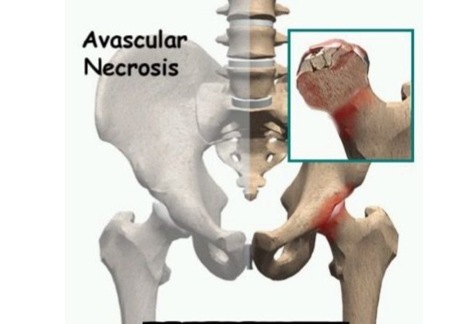 Orthopedic surgeon Dr Vishal Patil providing advanced Avascular Necrosis (AVN) treatment at Shree Orthopedic and Women’s Care Clinic in Aundh, Pune