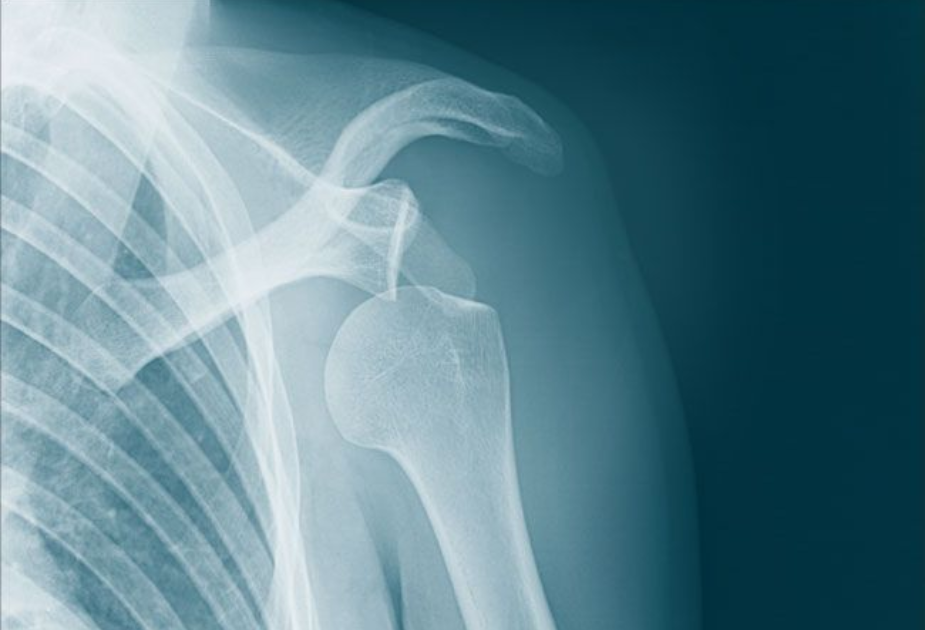 Orthopedic surgeon Dr Vishal Patil providing advanced recurrent shoulder dislocation treatment at Shree Orthopedic and Women’s Care Clinic in Aundh, Pune
