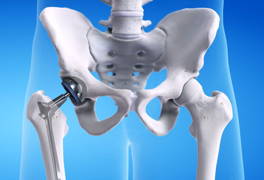 Orthopedic Surgeon Dr Vishal Patil performing advanced Total Hip Replacement Surgery at Shree Orthopedic and Women’s Care Clinic in Aundh, Pune